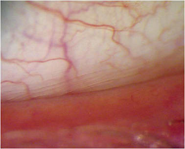 Figure 1. Lid parallel conjunctival folds (LIPCOFs).