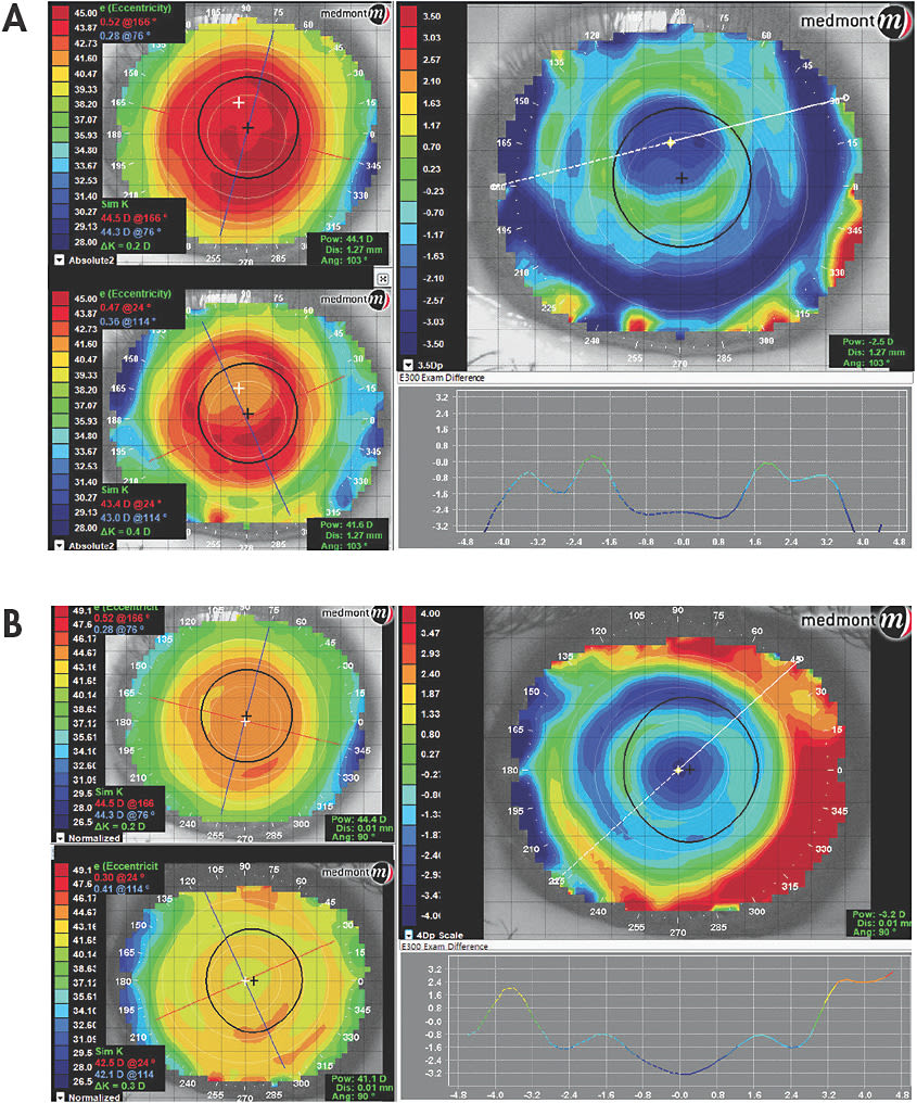 Figure 1. (A) A center-distance aspheric soft multifocal lens that has inadequate sagittal depth and is decentering on the eye. (B) After increasing the sagittal depth (deepening), the lens is better able to center over the patient’s visual axis and within the pupil to provide the necessary optics for optimal visual performance at distance and near.