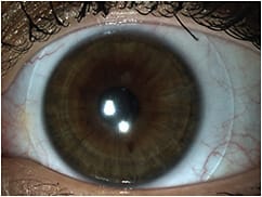 Figure 2. Applying a coating to the lens can improve surface wetting and help prevent contact lens dryness and discomfort (video online).