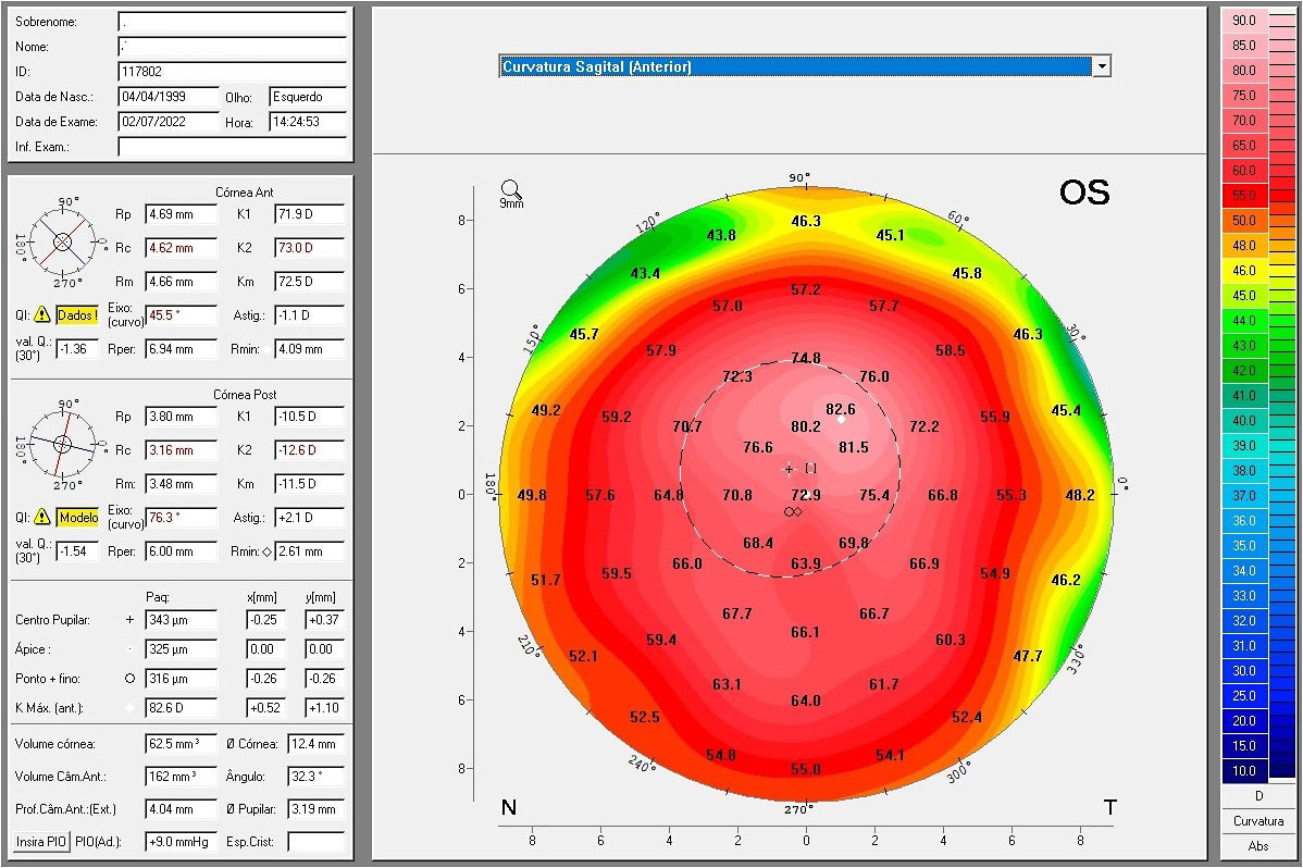 Figure 5. The anterior sagittal curvature map from corneal tomography.