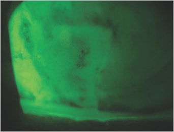Figure 1. Sodium fluorescein photo demonstrating characteristic wedge-like staining pattern of LSCD.