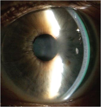 Figure 2. Image of a well-aligned scleral lens over a scarred cornea.