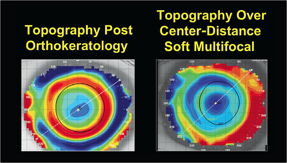 Figure 2. Corneal topography post-ortho-k is similar to that of topography over center-distance soft multifocal lenses.