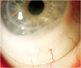 Figure 8. A scleral lens with central clearance, good haptic alignment, and conjunctival prolapse as seen on the eye of a patient after corneal transplantation.