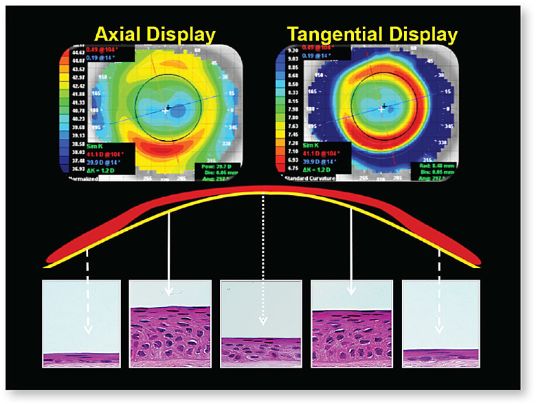 Figure 6. Epithelial changes following ortho-k treatment, easily identified on tangential display. Areas of lower elevation (blue) indicate epithelial thinning; higher elevation (red) indicates epithelial thickening.