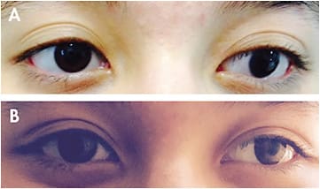 Figure 2. (A) A teenager with microcornea of the left eye; (B) The same patient fitted with computer-generated colored lenses in both eyes, which helped her cosmetic appearance.