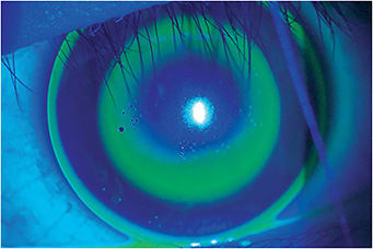 Figure 1. How can over-refraction help manage orthokeratology?