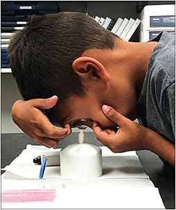 Figure 2. Consider prescribing scleral lenses to manage irregular astigmatism in children; this population is often able to successfully apply and remove these lenses themselves.