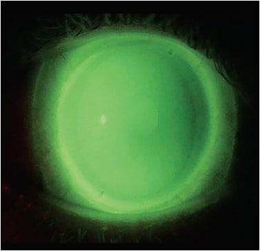 Figure 2. A Wratten #12 filter will block the cobalt light, producing a bright, flourescent-green image.