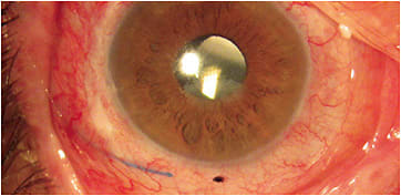 Figure 1. Scleral lens at dispense for GVHD.