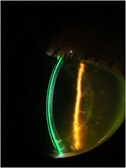 Figure 8. Slit lamp cross-section view OD.