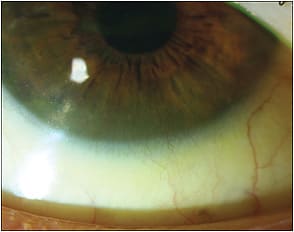 Figure 1. A 66-year-old female contact lens wearer developed corneal neovascularization post-burn from contact lenses soaked in makeup remover.&amp;#xA;Courtesy of Marta Fabrykowski, OD&amp;#xA;