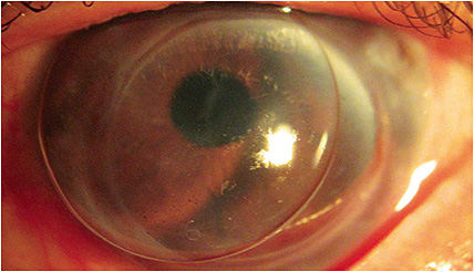 Figure 1. A 10mm corneal GP lens with prism.