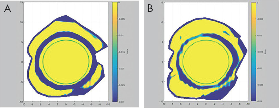 Figure 1. An impression ring immediately after scleral lens removal (A) and 30 minutes later (B).