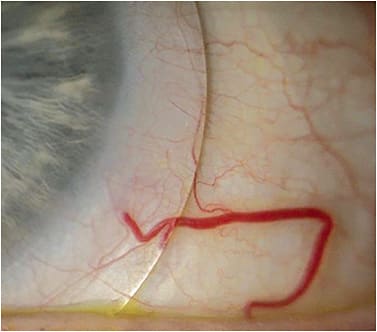 Figure 5. A diffusing filter improves the visibility of conjunctival vessels in the scleral landing zone.