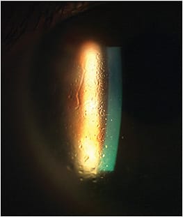 Figure 2. Non-wetting on the anterior surface of a scleral lens.