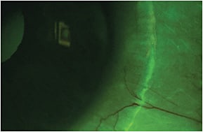 Figure 6. Conjunctival tissue stained with fluorescein corresponding to lens edge impingement.