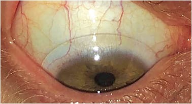 Figure 1. Scleral lens image provided by a patient. Note the superior-temporal fine vessel blanching from 9 o’clock to 11 o’clock, the shadow present from 11 o’clock to 1 o’clock (indicating edge lift), with alignment from 1 o’clock to 3 o’clock. Images courtesy of Dr. John D. Gelles