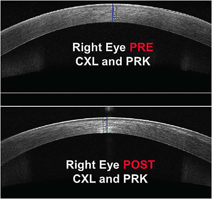 Figure 3. Right eye optical coherence tomography pre-CXL and PRK (top) and post-CXL and PRK (bottom). Note the central corneal thinning of the post-surgical image.