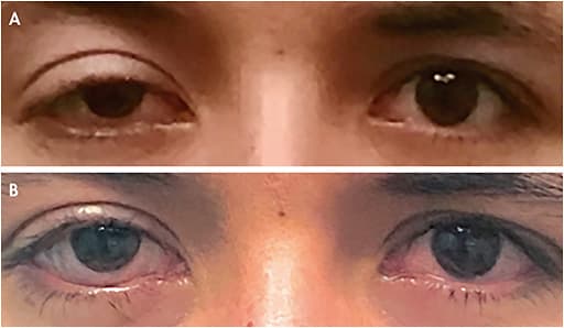 Figure 1. (A) A patient who has ptosis that did not improve with blepharoplasty; (B) the same patient wearing a scleral lens that improved the cosmetic appearance of the ptosis.