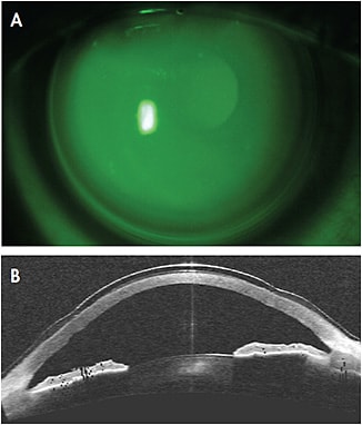 Figure 2. Optimal fitting of a hybrid lens for irregular corneas: front (A) and profile (B) view.