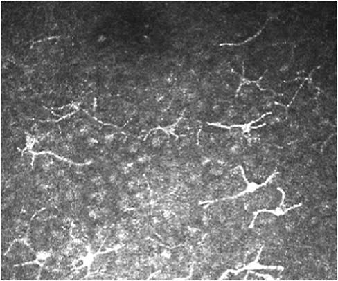 Figure 1. Dendritic cells in the bulbar conjunctiva, as imaged using clinical confocal microscopy. 
Image courtesy of Noor Haziq Saliman