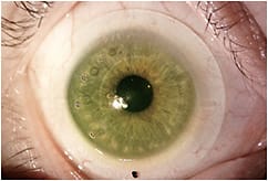 Figure 2. Air bubbles noted in the tear reservoir after five hours of scleral lens wear secondary to lens movement with blink.