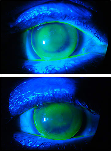 Figures 3 and 4. OD and OS lens fits in 2008. There was a slight corneal erosion below the central cornea OS.