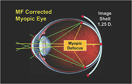 Figure 3. The myopic defocus created by a center-distance multifocal soft lens that corrects both the foveal and peripheral refractive errors.