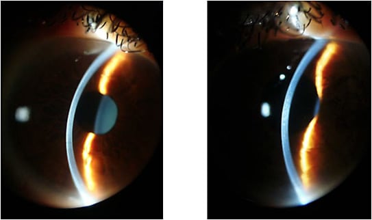 Figures 5 and 6. Cross-section view: OD and OS, respectively.