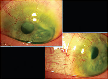 Figure 2. Diagnostic scleral lens on the patient&#x2019;s left eye.