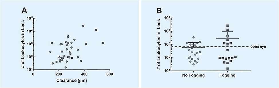 Figure 3. Measurement of leukocytes in midday fogging (MDF). Leukocytes were measured and plotted against fluid reservoir clearance (A), which shows a trend of increasing leukocytes with increasing clearance. Mean leukocytes were also compared in MDF and non-MDF subjects (B) showing an average of 2,768 ± 6,575 leukocytes in the MDF eyes and 587 ± 793 in the non-MDF eyes (P = 0.18). Modified and published with permission from Postnikoff CK, Pucker AD, Laurent J, Huisingh C, McGwin G, Nichols JJ. Identification of Leukocytes Associated With Midday Fogging in the Post-Lens Tear Film of Scleral Contact Lens Wearers. Invest Ophthalmol Vis Sci. 2019 Jan;60:226-233.