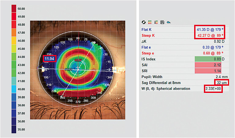 Figure 1. Post-ortho-k map with numerical values in article highlighted.