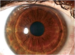 Figure 1. A well-centered hybrid lens on a regular cornea.