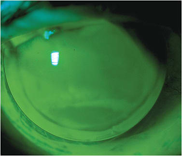 Figure 1. A post-penetrating keratoplasty patient successfully fit in a reverse geometry corneal GP lens.