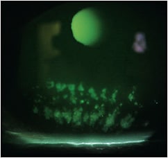 Figure 1. Corneal staining pattern mimicking meibography images.