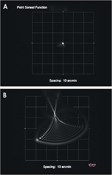 Figure 1. (A) A sharp point spread function map of a retina seeing a point source of light. (B) A distorted point spread function map of an uncorrected 31-year-old male who had keratoconus.