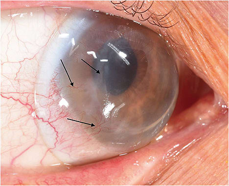 Figure 7. Scleral lens over an eye that underwent corneal transplant surgery and has scarring and neovascularization. Image courtesy of Edward Boshnick.