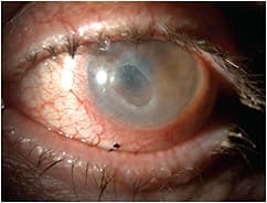 Figure 1. Neurotrophic corneal ulcer with peripheral neovascularization wearing a large diameter scleral contact lens.Photo courtesy of Suzanne Walter Sherman, OD.