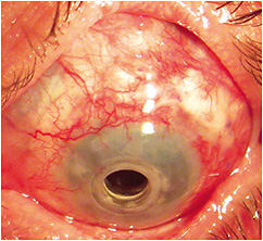 Figure 2. Successfully fit scleral lens.