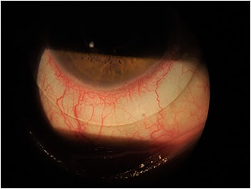 Figure 6. Inferior view of the haptic and sclera.