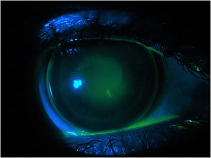 Figure 1. GP keratoconus fitting refit.