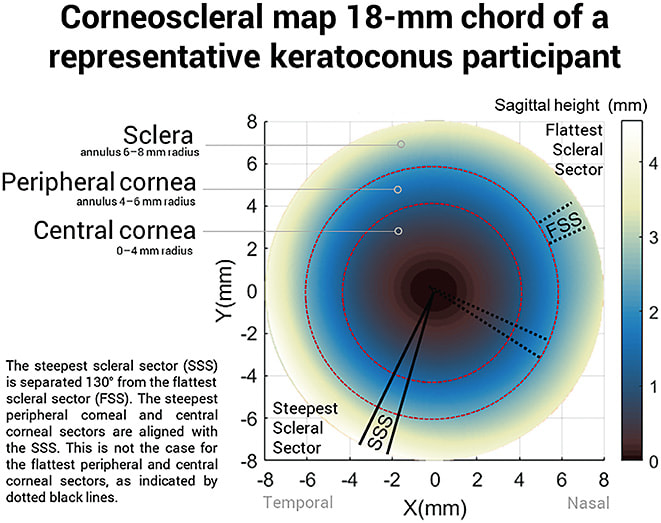 Figure 3. Corneoscleral map showing that there is not always a correlation between corneal shape and scleral shape in keratoconus patients.
Image courtesy of Dr. Alejandra Consejo.