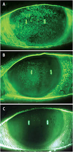 Figure 1. (A) Stage 1 NK at baseline. (B) 2.5 months post-therapy with 50% resolution. (C) Resolving NK with maintenance regimen.