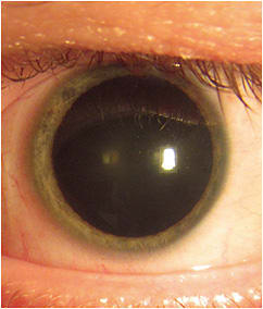 Figure 1. Permanent dilation following ocular trauma.