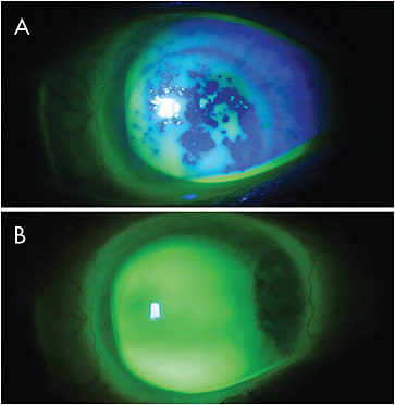 Figure 2. (A) Non-wetting scleral lens in a patient who has GVHD. (B) Surface wetting achieved with PEG-based coating.