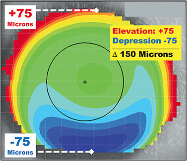 Figure 7. Elevation map of the keratoconic cornea in Figure 5.