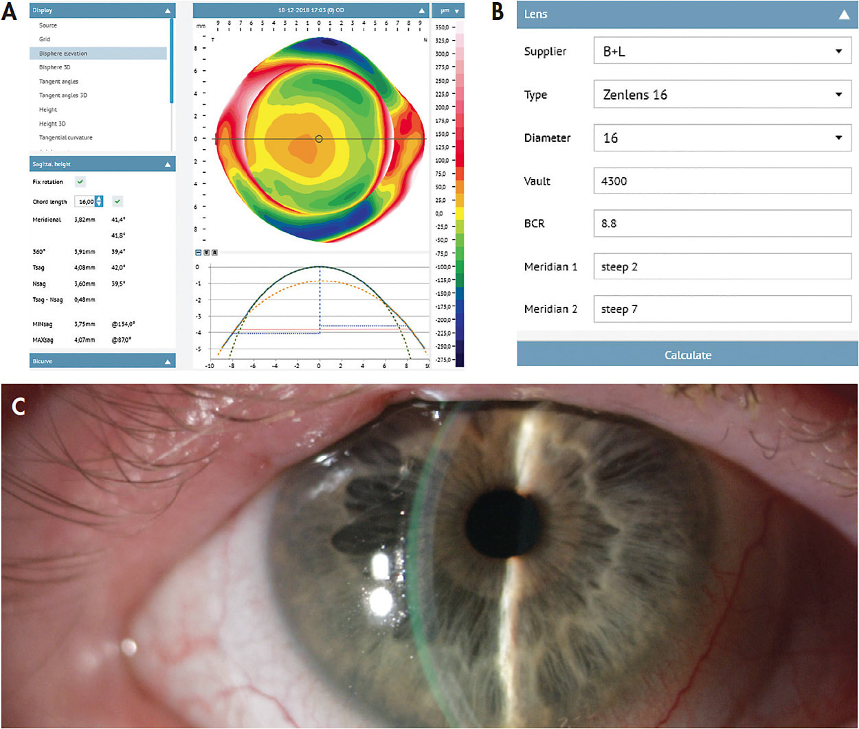 Figure 2. (A) Corneoscleral topography showing the different ocular sagittal heights at 16.00mm. (B) The software calculation of the best lens fit of a specific design commercially available. The lens sagittal height calculated in this case is 4,300µm. (C) Fitting assessment of the first lens selected from the diagnostic set showing adequate vault and peripheral alignment. The selection concept consists of choosing the closest lens to the calculation made by the software with the higher sagittal height. In this case, the initial lens sagittal height chosen is 4,500µm.