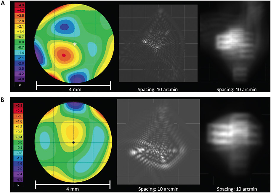 Figure 6. Higher-order aberrations measured in (A) an individual who underwent a corneal transplant following RK surgery (HO RMS = 2.375µm), and (B) an individual who underwent RK refractive surgery (HO RMS = 1.225µm).