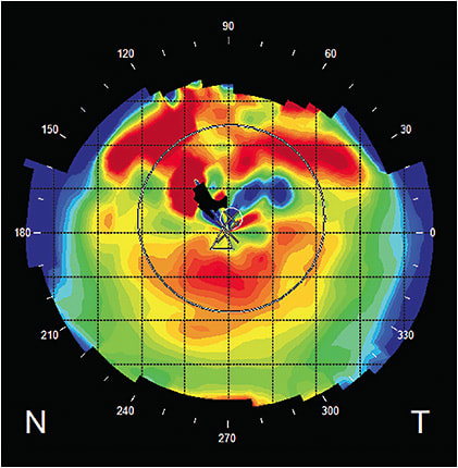 Figure 1. Postoperative corneal topography of the left eye.